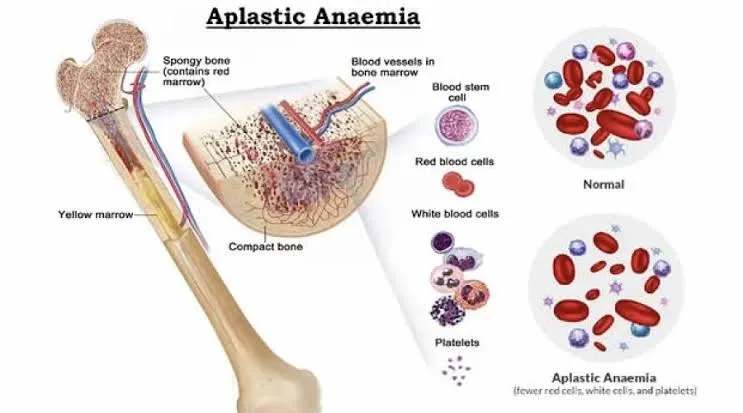 Mengenal Anemia Aplastik dan Kanker Mulut: Penyakit Langka yang Menimpa Tika Mega Lestari (foto/indopop)